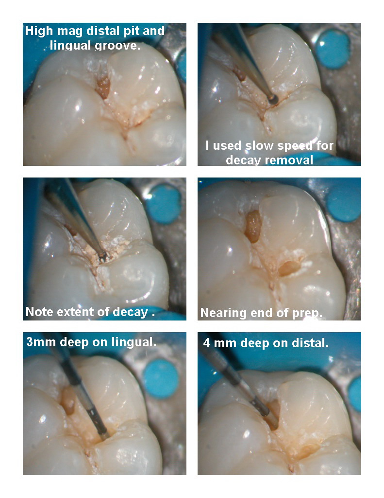Microdental lower molar pg 2.jpg